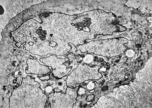 F,16y. | bone marrow - malignant histiocytosis